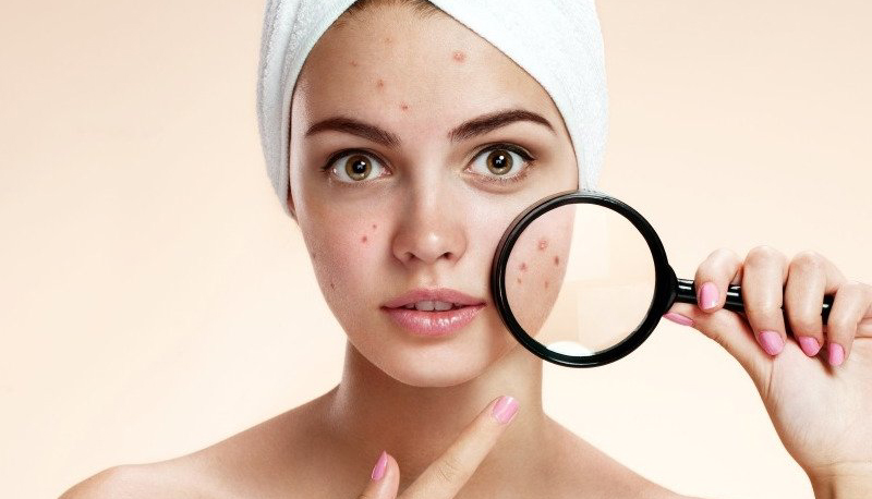 Hai i brufoli? Sei più bravo a scuola: lo dice la Scienza