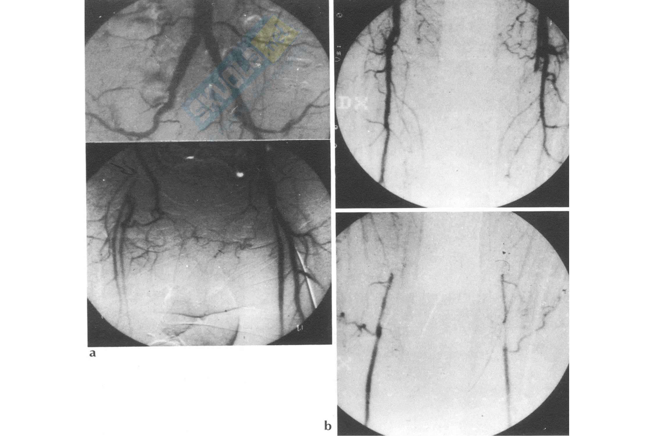 Cardiochirurgia - arteriopatia cronica ostruttiva arti inferiori Pag. 26