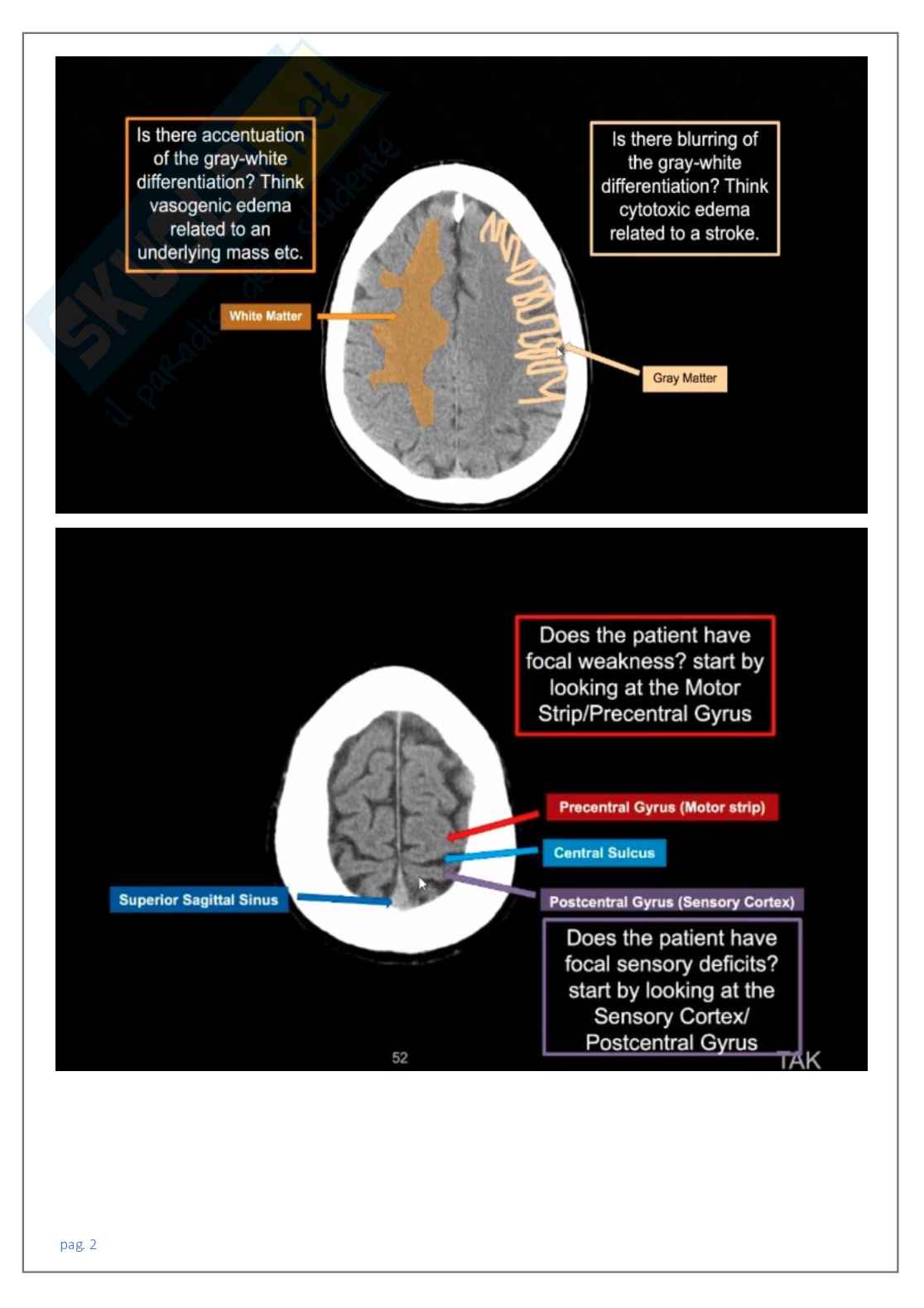 Neuroradiologia tc Pag. 2