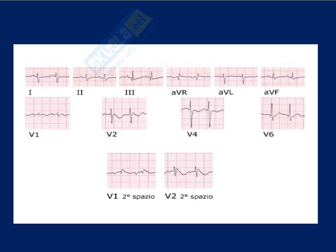 Pattern di Brugada e malattia di Kawasaki: su di un caso clinico Pag. 36